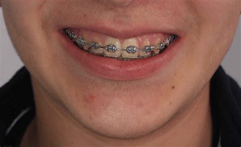 precio brackets metalicos ortodoncia|ortodoncia brackets precio.